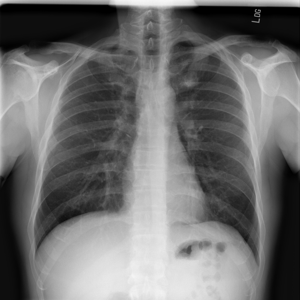 AI-Powered Chest X-ray Pathology Detection